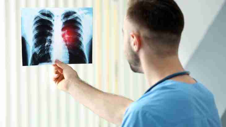 claim mesothelioma compensation overseas