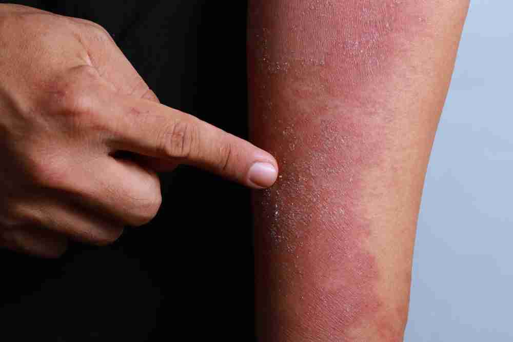 carpenter pointing to contact dermatitis on exposed arm