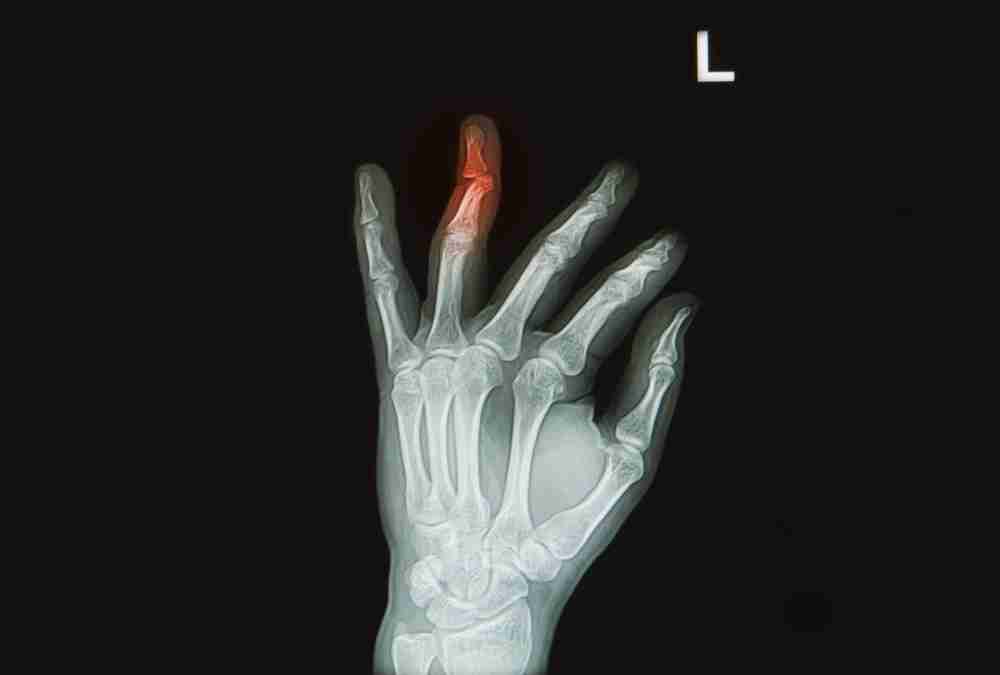 Fractured finger crush injury x-ray