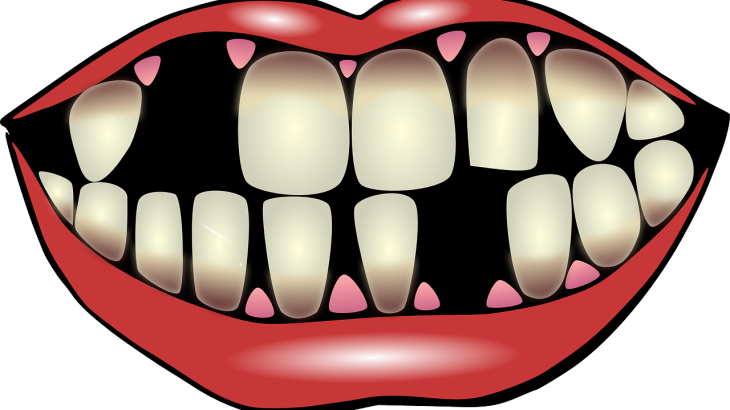 Illustration of a mouth with missing teeth